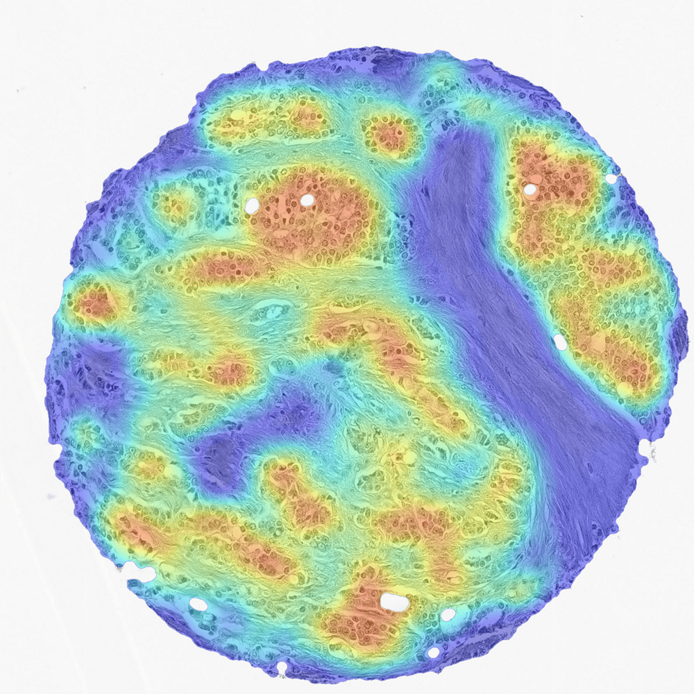 AI grading of prostate cancer image